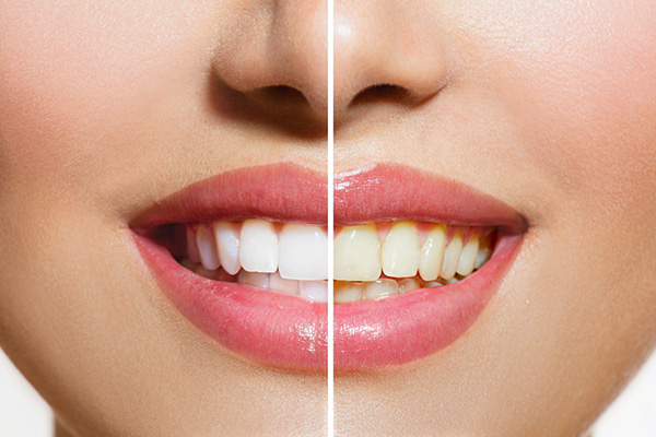 Usos surpreendentes do óleo de coco - Branqueia os dentes